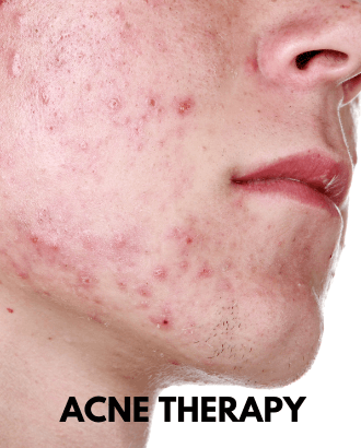 Active Acne Therapy